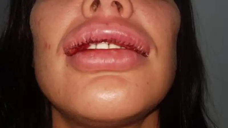Алматинки едва не лишились губы и носа
