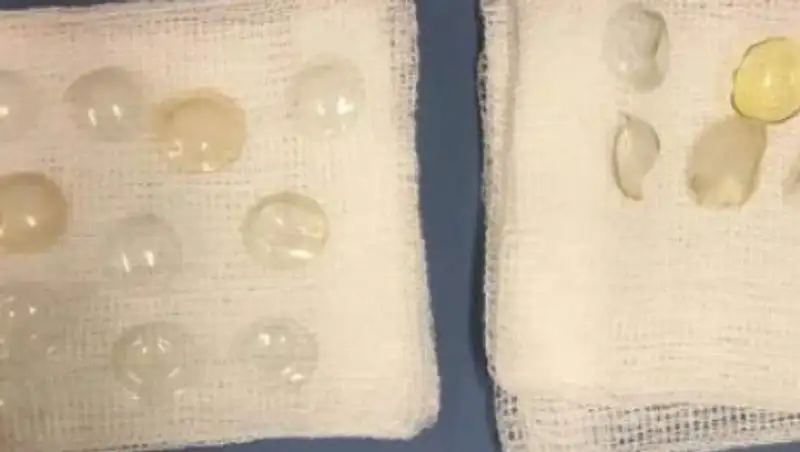 Пенсионерка из Британии забыла у себя в глазу 27 линз