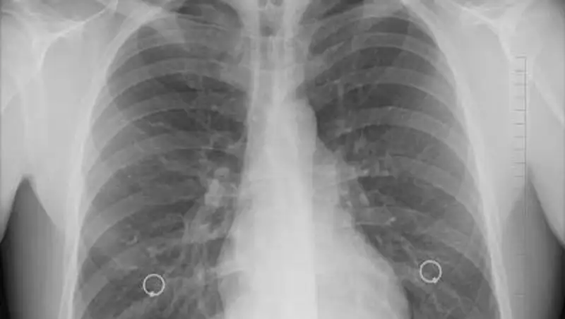 Хирург сравнила легкие курильщика с легкими после COVID