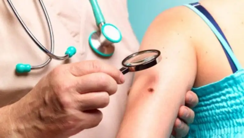 ВКО и СКО занимают второе место в стране по заболеваемости меланомой