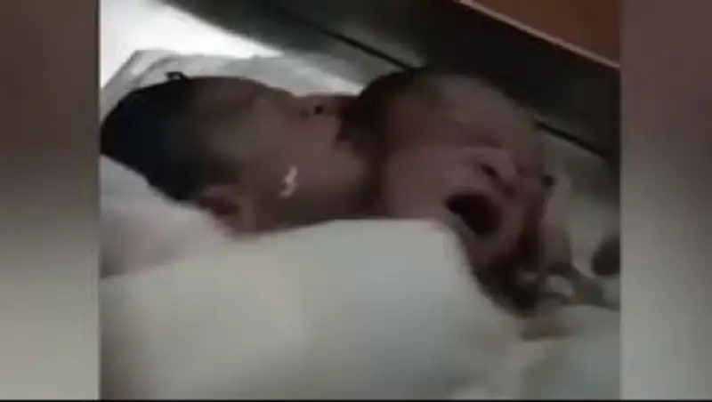 В Индии родился ребенок с двумя головами