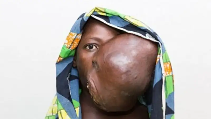 Опухоль на лице размером с футбольный мяч чуть не задушила девочку