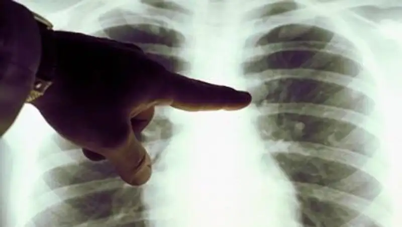 В Минздраве объяснили резкий рост заболевших пневмонией