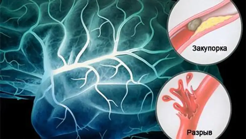 В Москве будут делать лекарства от инсультов