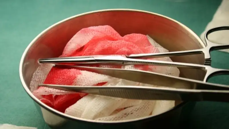 В Колумбии успешно разделили сиамских близнецов