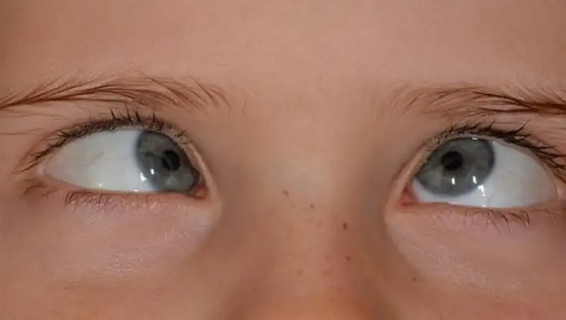 Как лечится косоглазие у детей и у взрослых