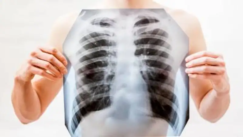 Обновлены данные по заболеваемости пневмонией в Казахстане