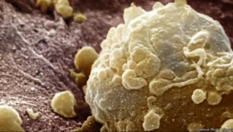 В Британии вводят иммунотерапию рака легких и кожи