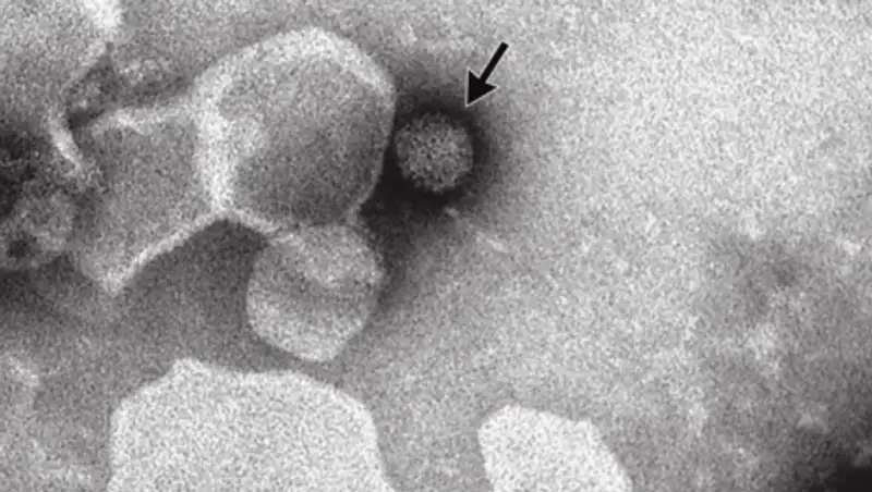 Полный геном вируса Зика был извлечен из мозга ребенка с микроцефалией