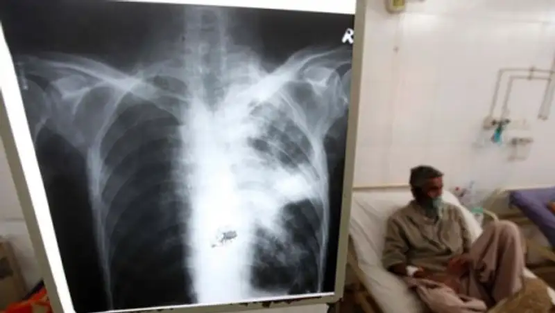 Ученые открыли механизм самоуничтожения туберкулеза