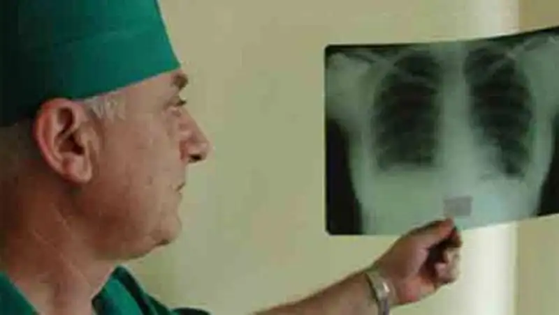 Число заболевших туберкулёзом в Казахстане снизилось в 2 раза