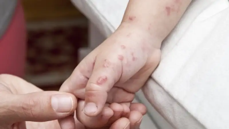 Ученые случайно нашли сверхэффективное лекарство от герпеса