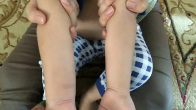 Столичные врачи прокомментировали ситуацию с аллергией на укусы комаров у детей