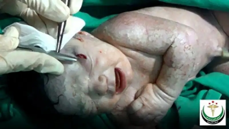 В Сирии родилась девочка со шрапнелью в голове