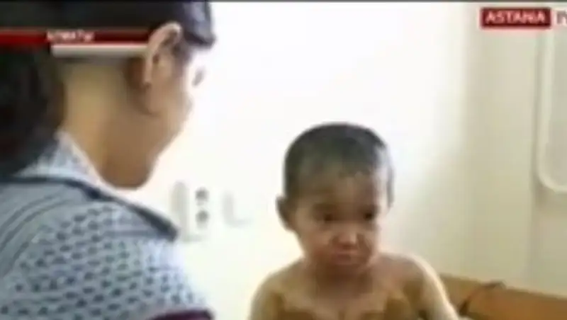 Минздрав готов отправить на лечение за рубеж 5-летнего ребенка, страдающего ихтиозом