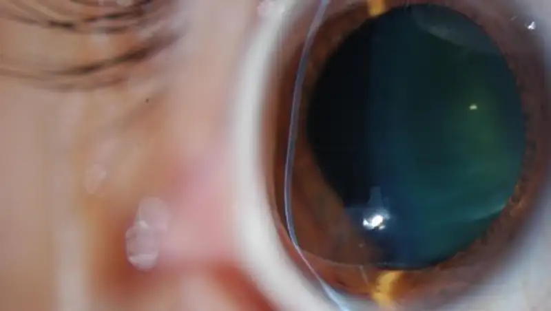 Что нужно знать о кератоконусе