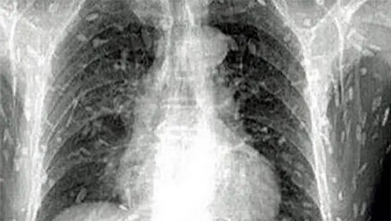 Любителя суши заполонили ленточные черви