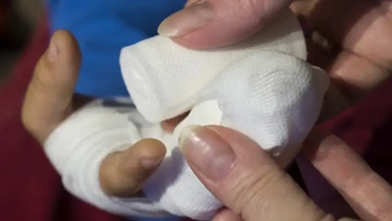 Детям-бабочкам в Алматы не хватает лекарств и бинтов