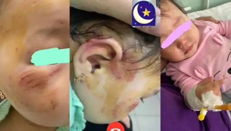 "Сотрясение, гематомы, ссадины" - мать о травмах избитой полуторагодовалой дочери