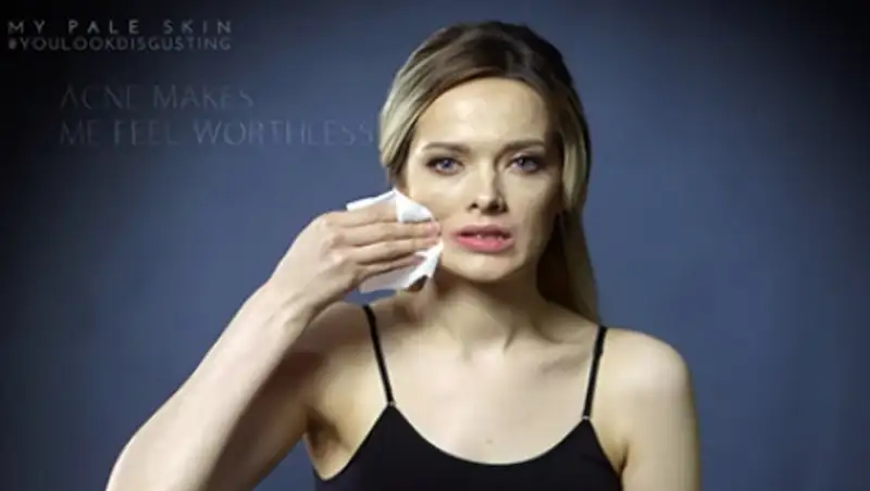 Видео в поддержку страдающих от акне посмотрели 8 миллионов раз за неделю