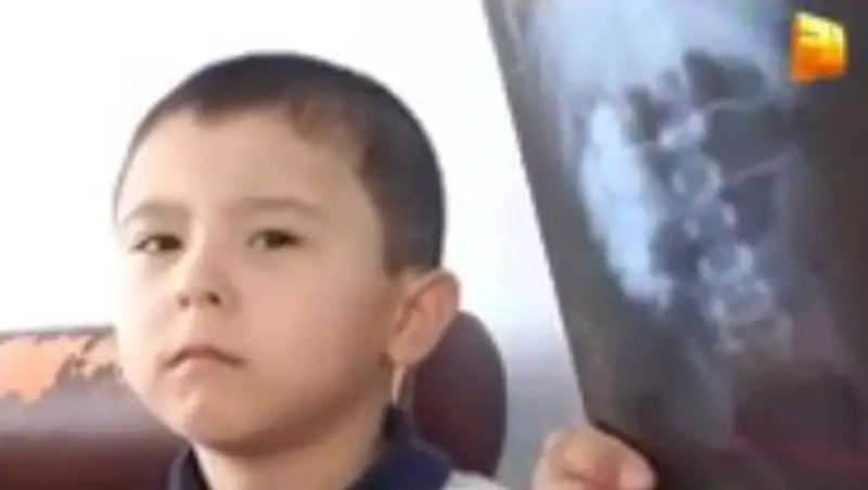 В Алматы 5-летнему ребенку с врожденной патологией отказали в социальном пособии