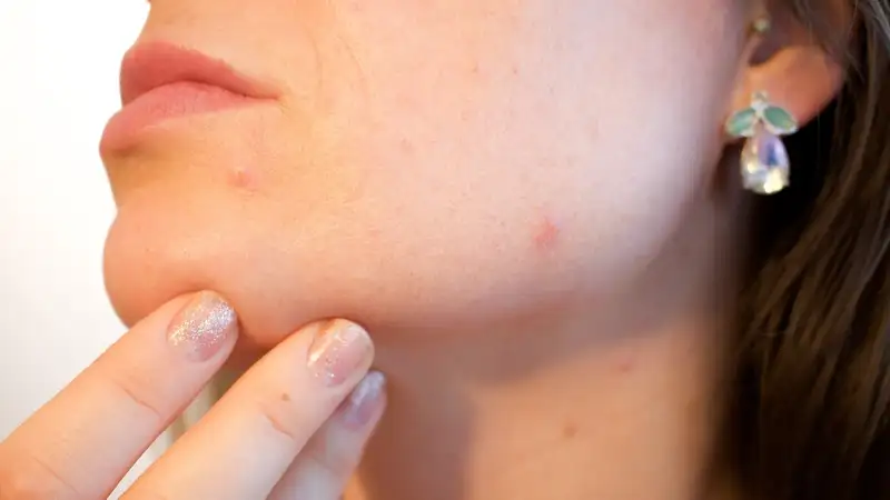 Гастроэнтеролог рассказала, почему появляются прыщи