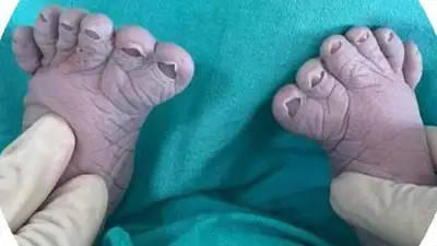 ребенок родился с лишними пальцами, фото - Новости Zakon.kz от 23.04.2024 00:18