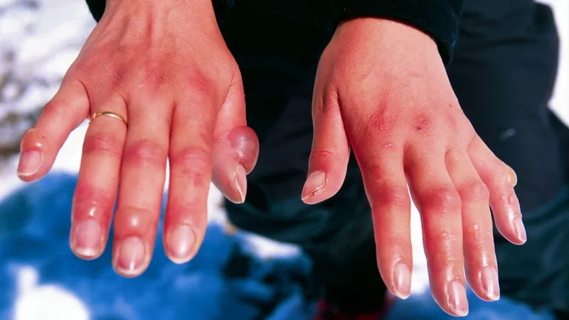 Как избежать обморожения конечностей и вовремя распознать признаки