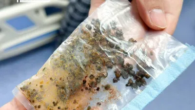 Больше 60 желчных камней извлекли хирурги у пенсионера в Павлодаре, фото - Новости Zakon.kz от 04.02.2025 19:41