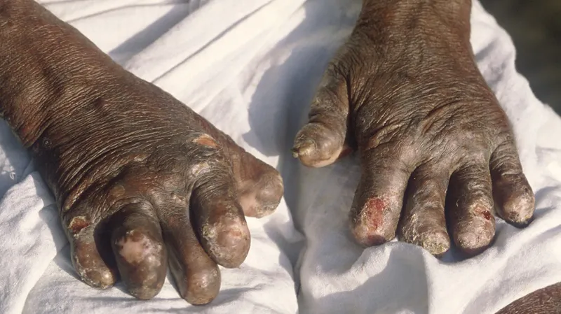 "Болезнь дьявола": какое заболевание в числе первых поразило человечество