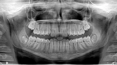 Рейнтген зубов и черепа, фото - Новости Zakon.kz от 26.08.2025 04:59