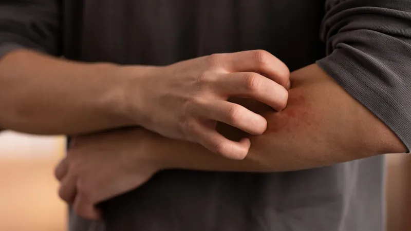 Врач рассказала, можно ли заболеть ветрянкой второй раз