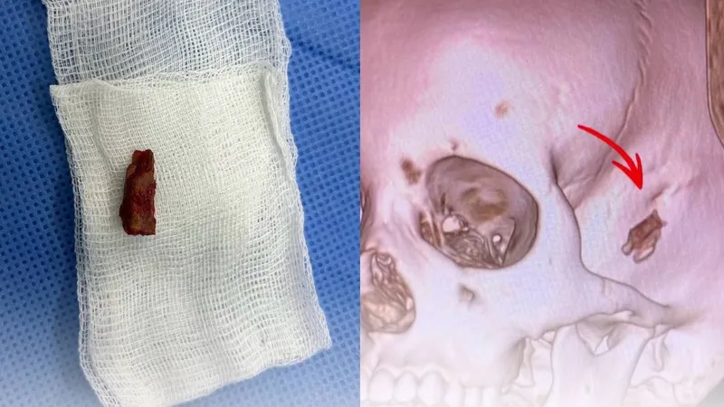 Мальчик пять лет прожил с обломком ветки в голове в Павлодаре