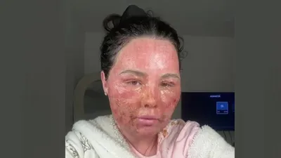 девушка пострадала от косметической процедуры, фото - Новости Zakon.kz от 16.01.2026 20:40