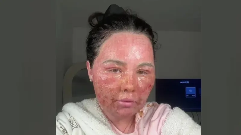 Пугающие последствия косметической процедуры показала британка