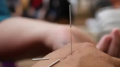 Иглотерапия, восточная медицина, фото - Новости Zakon.kz от 04.02.2026 11:15