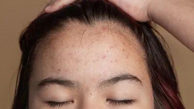 причины прыщей на лбу, фото - Новости Zakon.kz от 07.02.2026 13:44