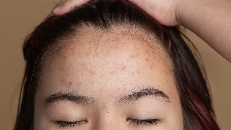 Стресс оставляет следы на лбу – дерматолог