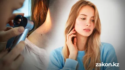 насколько опасны родинки и вызывают ли они онкологию, фото - Новости Zakon.kz от 16.02.2026 17:31